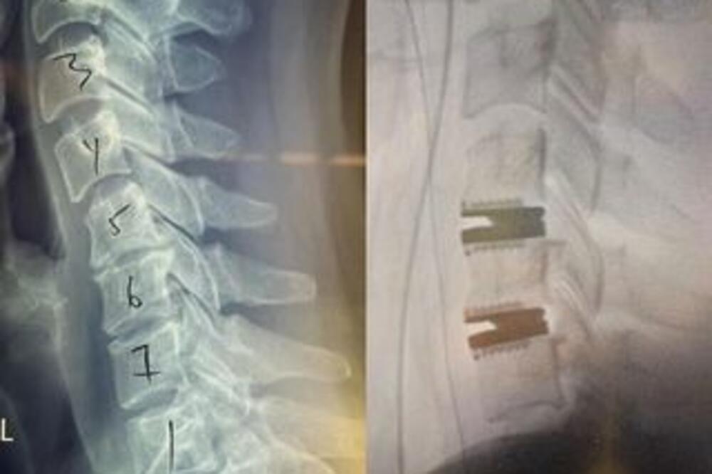 POLU ŽENA, POLU ROBOT?! HOLIVUDSKOJ GLUMICI UGRADILI DVA TITANSKA DISKA U VRAT: Frapiraće vas kako izgleda! (FOTO)