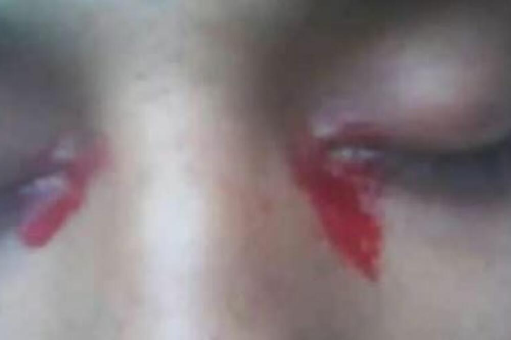 KRVAVE SUZE DEVOJKE ŠOKIRALE LEKARE: ''POMOZITE!'' Niko nije mogao da pretpostavi o čemu je reč!