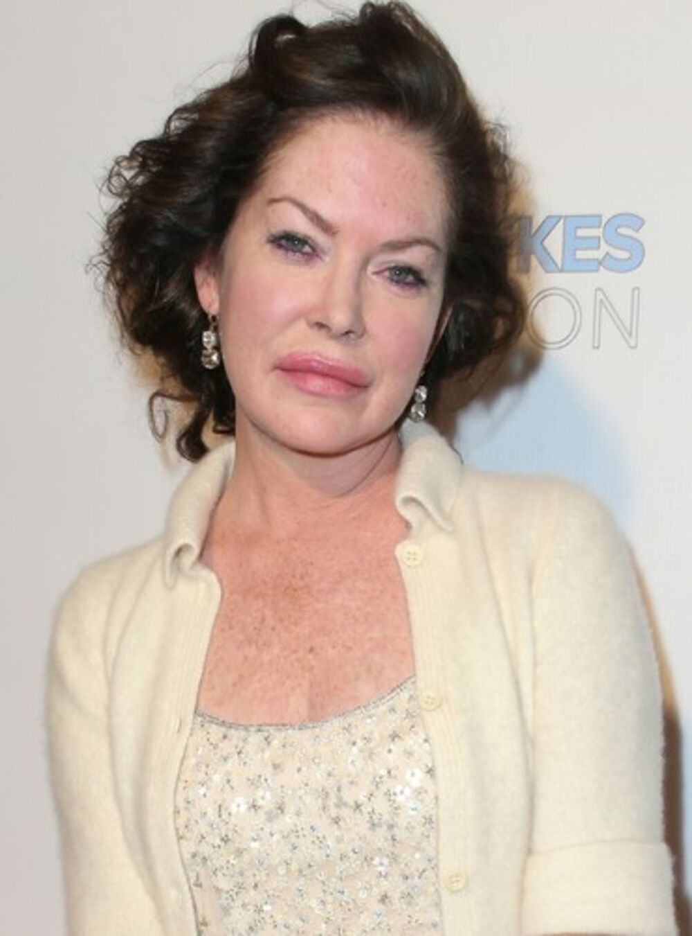 PLASTIČNE OPERACIJE I TE KAKO SU OSTAVILE TRAGA NA LARINOM LICU