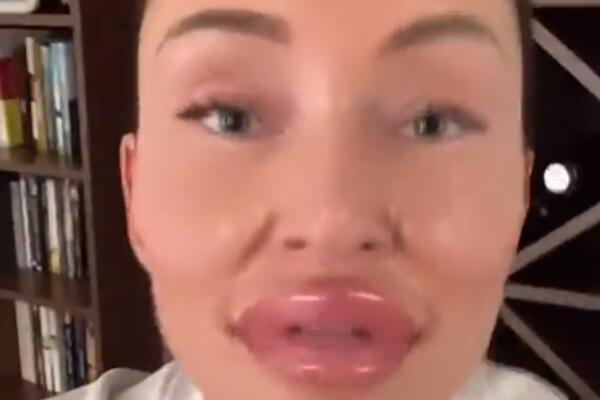 NAŠA PEVAČICA ŠOKIRALA POSLEDNJOM FOTKOM: Jagodice kao dve BRESKVE, usta do pola glave, a sve zbog BITNE PORUKE!