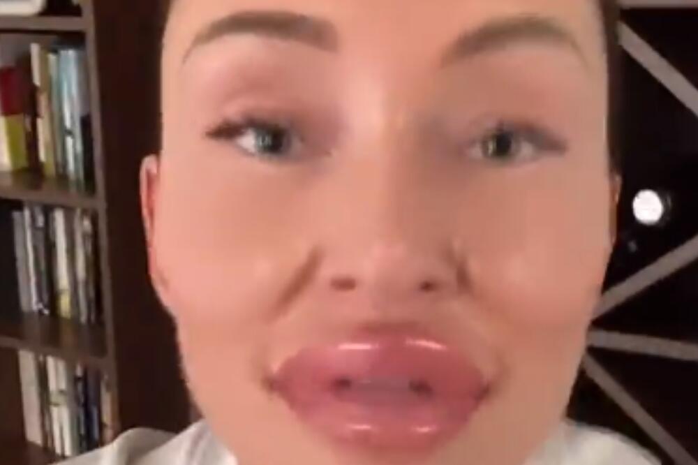 NAŠA PEVAČICA ŠOKIRALA POSLEDNJOM FOTKOM: Jagodice kao dve BRESKVE, usta do pola glave, a sve zbog BITNE PORUKE!