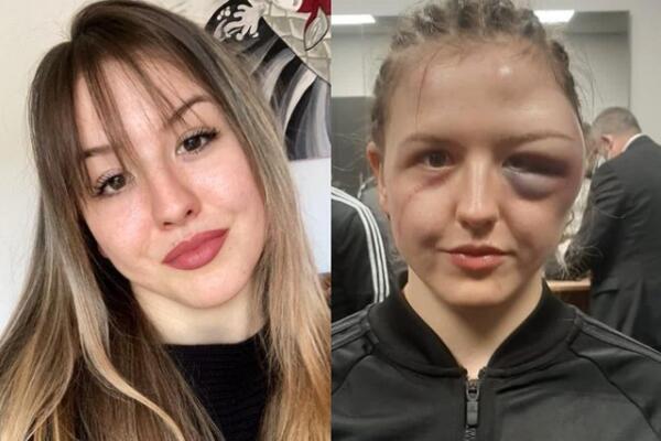 JEZIVO: Nemačkoj bokserki rivalka deformisala lice udarcima - i to prljavim! NE LIČI NA SEBE posle borbe! (FOTO)