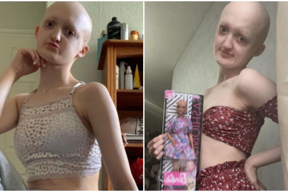 CEO ŽIVOT BILA NA METI VREĐANJA I MALTRETIRANJA ZBOG RETKOG SINDROMA: Gluva i bez kose, DANAS JE MODEL (FOTO/VIDEO)