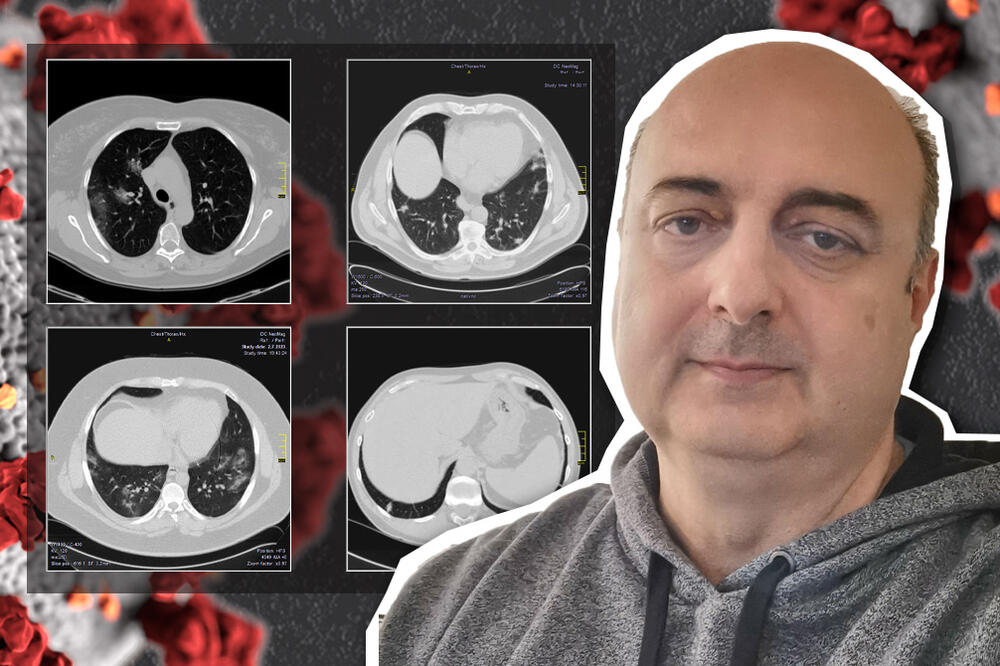 SRPSKI LEKAR OBJAVIO NEVIĐENE SNIMKE PLUĆA PACIJENATA: Da li je NOVI SOJ? KAO DA BOLEST NE MOŽE DA SAČEKA! (FOTO)