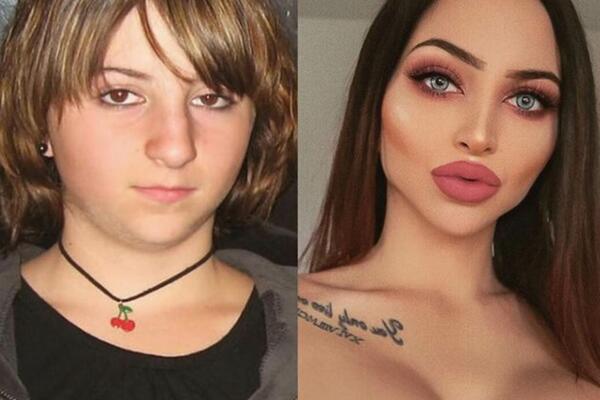 PRETEKLA JE SORAJU I KORAĆEVU! U PLASTIČNE OPERACIJE ULOŽILA JE OKO 35.000 EVRA: Da li je ona SILIKONSKA pobednica?