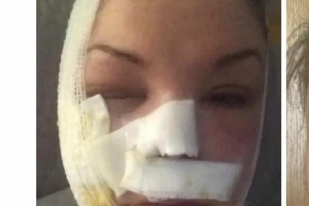 UMALO IZGUBILA ŽIVOT ZBOG JAJA! Probala trik za doručak sa jutarnjeg programa, završila u zavojima (FOTO)