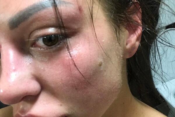 ISPLIVALE JEZIVE FOTKE MAJE MARINKOVIĆ NA KOJIMA JE BRUTALNO PRETUČENA: Cela modra, krvava i u MODRICAMA! (FOTO)