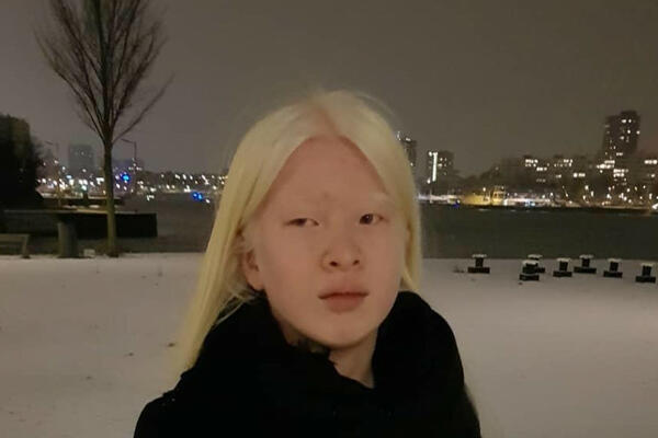 RODITELJI SU JE ZBOG ALBINIZMA NAPUSTILI KAO BEBU, A DANAS JE IME U SVETU MODE: Ima jako težak POREMEĆAJ!