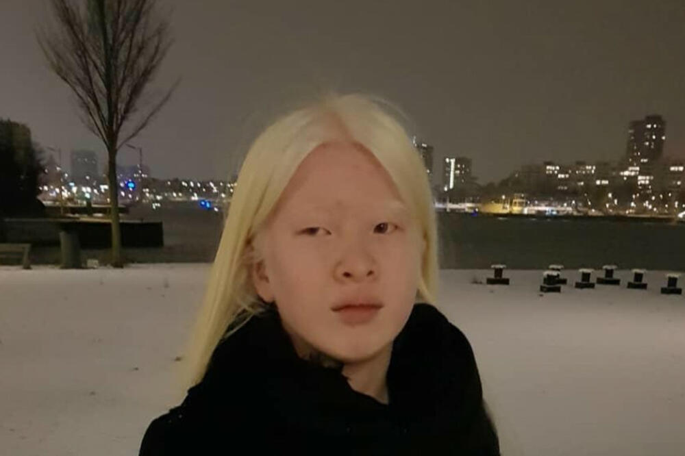 RODITELJI SU JE ZBOG ALBINIZMA NAPUSTILI KAO BEBU, A DANAS JE IME U SVETU MODE: Ima jako težak POREMEĆAJ!