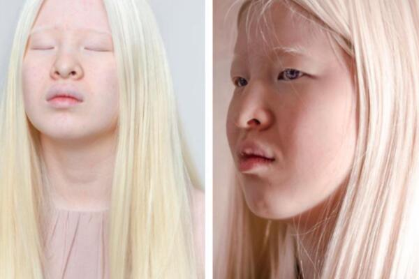 RODITELJI SU JE OSTAVILI ISPRED SIROTIŠTA ZBOG NEOBIČNOG IZGLEDA: Svoje prokletstvo pretvorila u BLAGOSLOV! (FOTO)