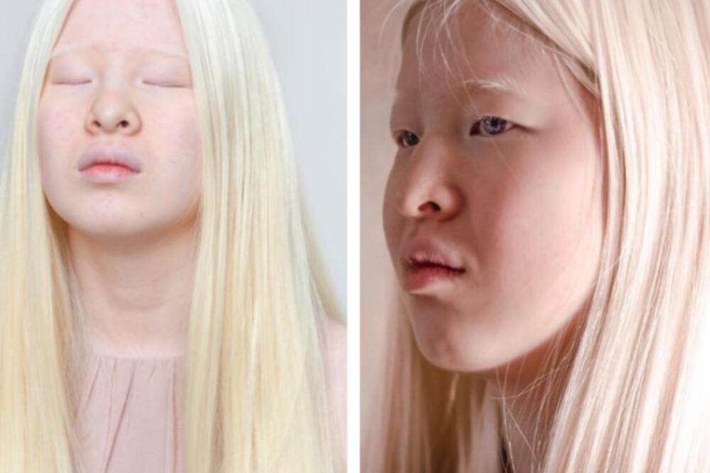 RODITELJI SU JE OSTAVILI ISPRED SIROTIŠTA ZBOG NEOBIČNOG IZGLEDA: Svoje prokletstvo pretvorila u BLAGOSLOV! (FOTO)