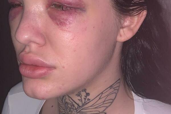 STRAVIČNO! SRPSKU STARLETU BRUTALNO PRETUKAO DEČKO: Krvnički joj lupao GLAVU O BETON, policija i hitna reagovale!