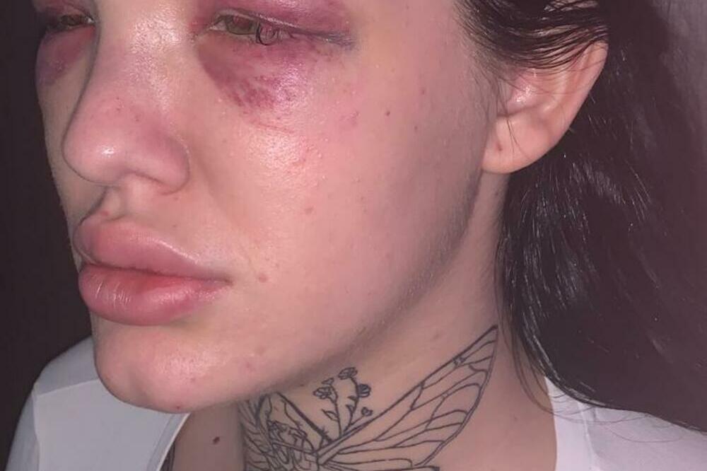 STRAVIČNO! SRPSKU STARLETU BRUTALNO PRETUKAO DEČKO: Krvnički joj lupao GLAVU O BETON, policija i hitna reagovale!