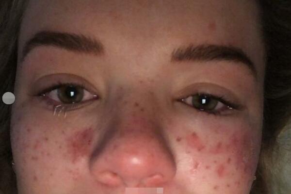 POSLUŠALA SAVET SA TIKTOKA ZA UKLANJANJE AKNI PA ZAVRŠILA U HITNOJ! Oslepela sam a lice mi je SPRŽENO!