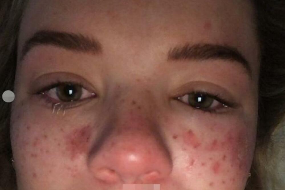 POSLUŠALA SAVET SA TIKTOKA ZA UKLANJANJE AKNI PA ZAVRŠILA U HITNOJ! Oslepela sam a lice mi je SPRŽENO!