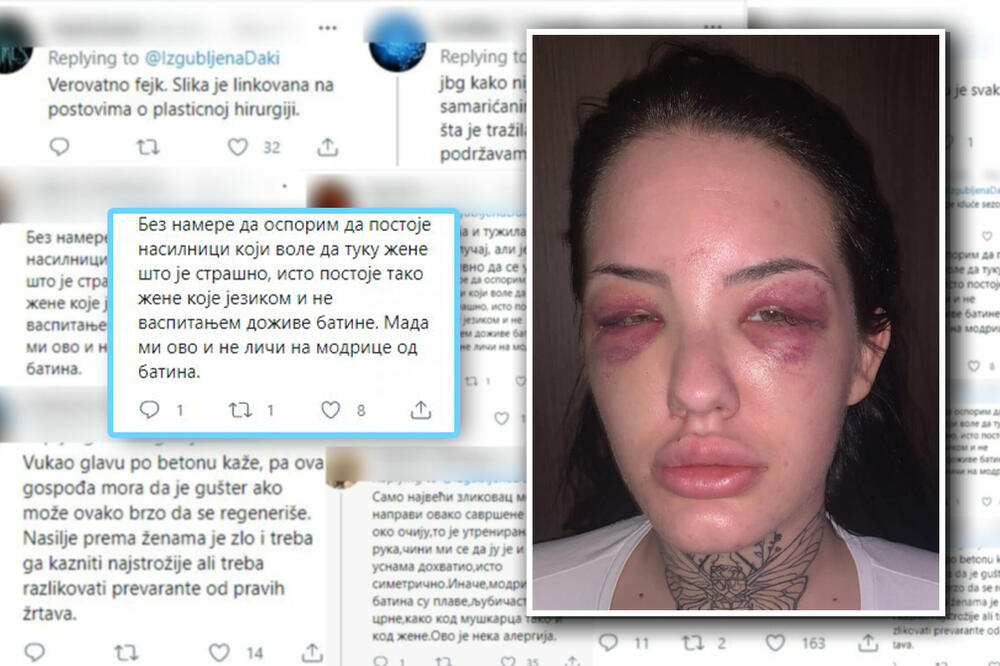 DEČKO JE VUKAO PO BETONU, A SAD JE OGAVNO RAZVLAČE PO TVITERU! Neki od komentara na Sarine modrice baš su bolesni