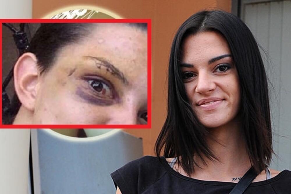 JEZIVO! TARA SIMOV PRETUČENA, MASNICE, PODLIVI I MODRICE UZNEMIRIJUĆE: Ošišana na ĆELAVO, krvave oči i pogled JEZA!