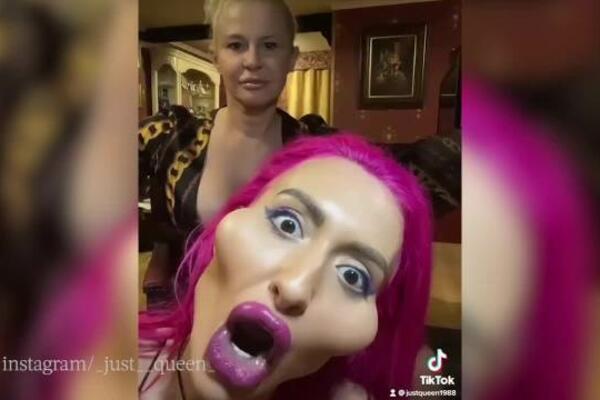 NAPRAVILA OD SEBE KARIKATURU! STARLETA SAMA SEBI UBRIZGALA FILERE U LICE: Da se čovek ISPOVRAĆA kada vidi-FUJ!