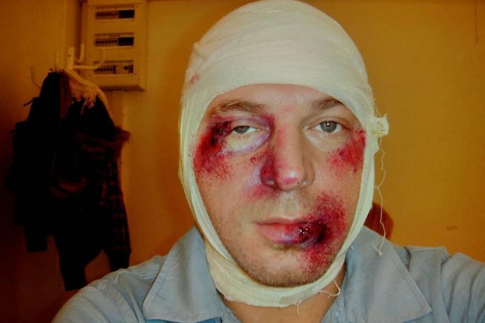 DOMAĆI GLUMAC SAV KRVAV I U ZAVOJIMA! Prebila ga žena oklagijom zbog se*si scena sa koleginicom! (FOTO)