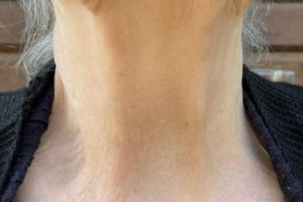 MISLILA JE DA IMA ZAUŠKE PA JE NAPIPALA KVRGU NA VRATU: Lekari su joj saopštili UŽASNU VEST, SVAKOME SE MOŽE DESITI