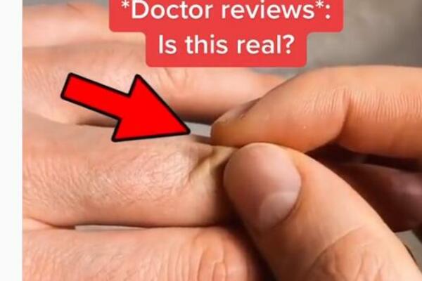 KAKO MOŽETE SAMI DA PROVERITE DA LI STE DEHIDRIRALI? Dr Rajan otkriva sve detalje (VIDEO)