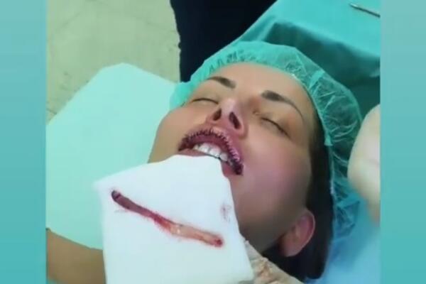 DALILA DRAGOJEVIĆ SE OPERISALA! UZNEMIRUJUĆE SCENE NAKON INTERVENCIJE: Svuda krv, ona nepomično leži! (FOTO)
