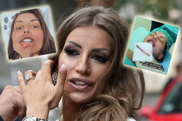 ISPLIVALE PRVE FOTKE NAKON INTERVENCIJE, VADILA JE SILIKON! Dalila sva u KONCIMA, ali izgleda MNOGO BOLJE!