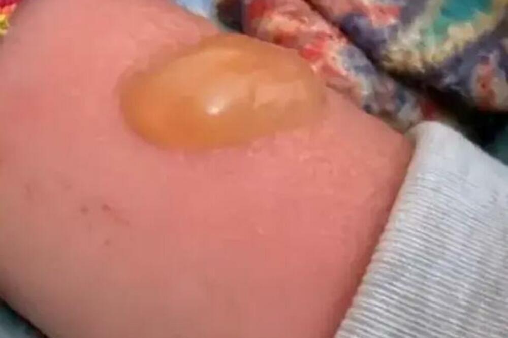 JEZIVO: Na Internetu kruže fotke na kojima se vide strašne OPEKOTINE prouzrokovane SUNCEM, nije za šalu! (FOTO)