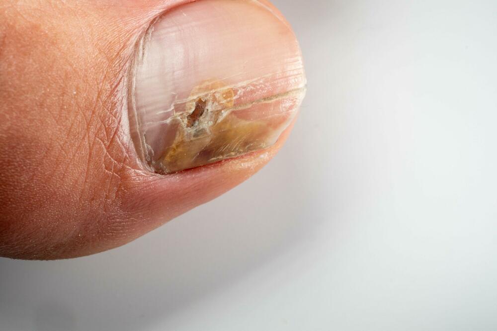 GLJIVIČNE INFEKCIJE NOKTIJU SU VEOMA ČESTE: Evo koji su SIMPTOMI i kada je vreme da se obratite LEKARU