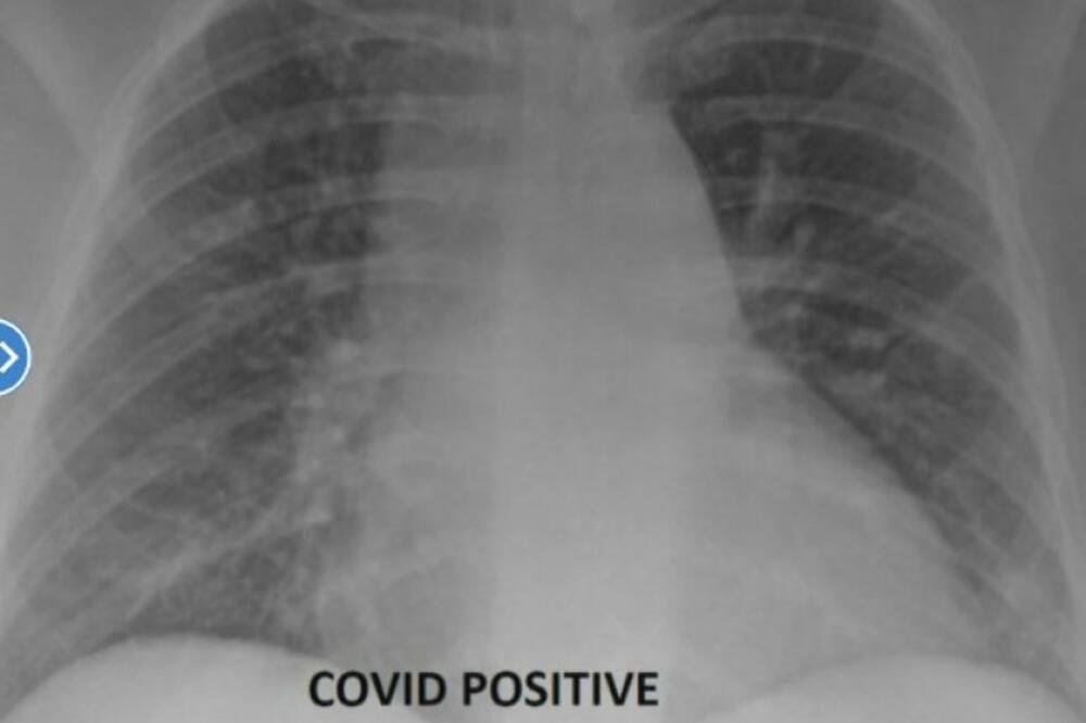 OGROMNA RAZLIKA: Doktor pokazao snimke PLUĆA vakcinisanih i nevakcinisanih zaraženih pacijenata (FOTO)