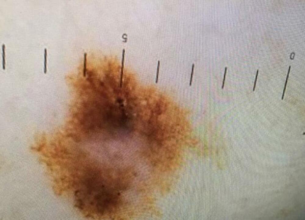 Dobila opasan melanom