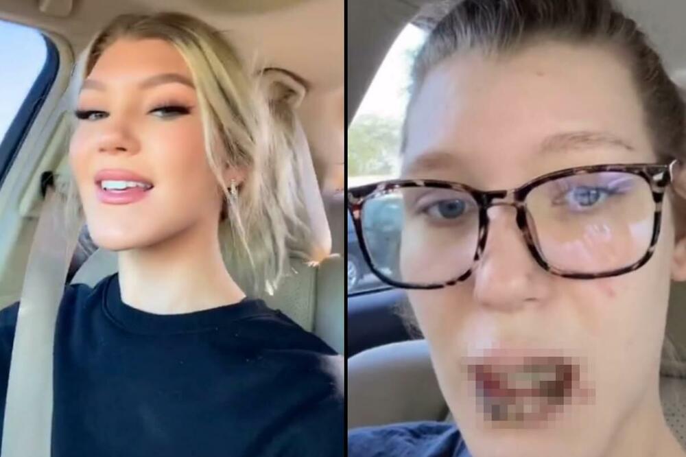 DOBILA DELTA SOJ KORONE PA POKAZALA JEZIVI SIMPTOM NA USNAMA: Prvo su počele da se ljušte, OVO JE HOROR (VIDEO)