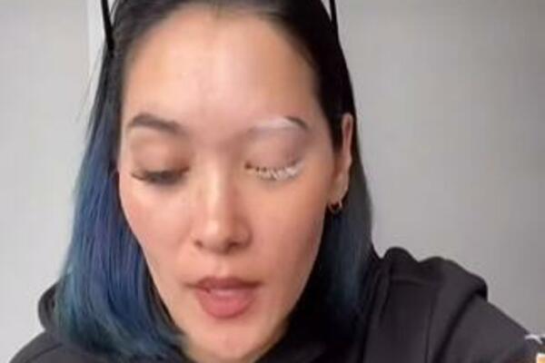 POBELELE JOJ TREPAVICE I JEDNA OBRVA! Dobila je RETKO OBOLJENJE, pa upala u UŽAS