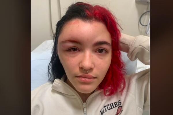 DOBILA JE ALERGIJU I FACA JOJ SE IZDEFORMISALA: Veoma je opasno, ONA JE ŽIVO UPOZORENJE! (VIDEO)