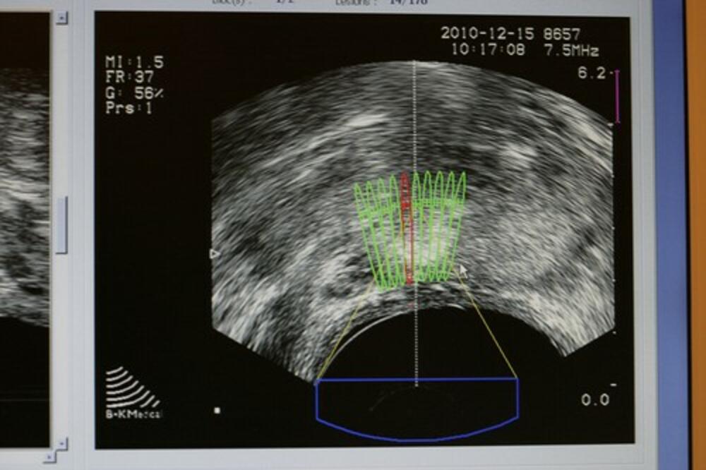 REVOLUCIONARNO: Naučnici misle da će moći da izleče RAK PROSTATE za nedelju dana?!