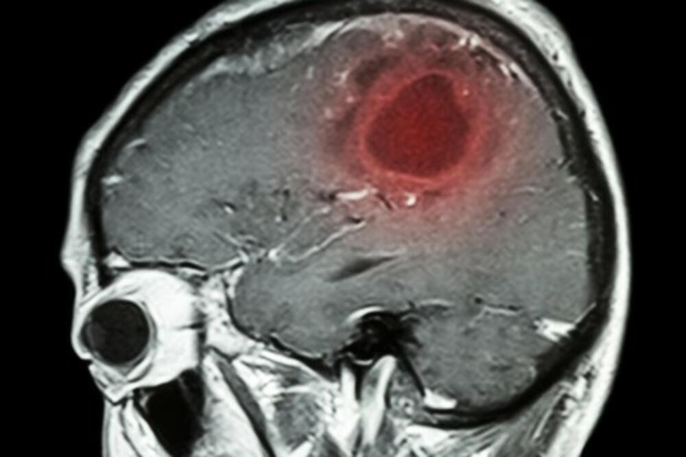 7 NAIZGLED BEZAZLENIH SIMPTOMA KOJI UKAZUJU NA TUMOR MOZGA: Važno je da ih prepoznate