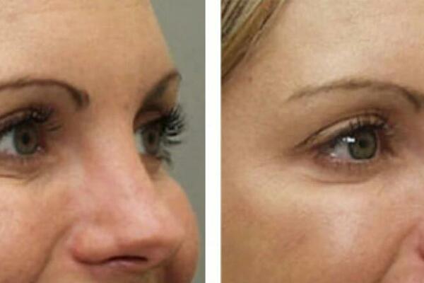 ČUDESNA MASKA ZA PEGLANJE BORA: Uz samo 3 sastojka dobićete kožu kao posle plastičnog hirurga