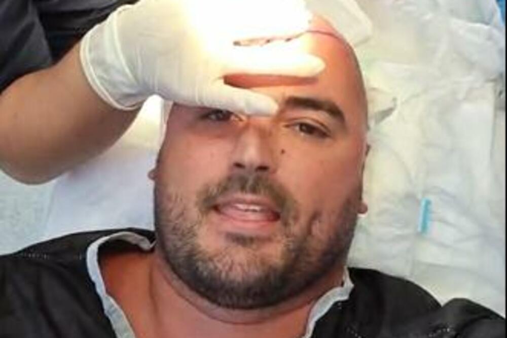 REZULTAT TRANSPALNTACIJE SE VEĆ VIDI! Alen Hadrović više nije ćelav, zadovoljno pokazao da mu RASTE KOSA! (FOTO)