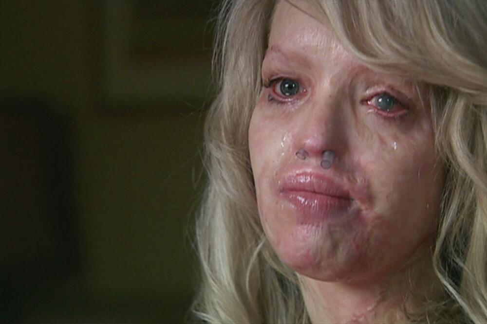 BILA JE PRELEPA, A ONDA JOJ JE DEČKO BACIO KISELINU U LICE I UNIŠTIO JU JE: Morala je da izvrši 200 operacija! FOTO