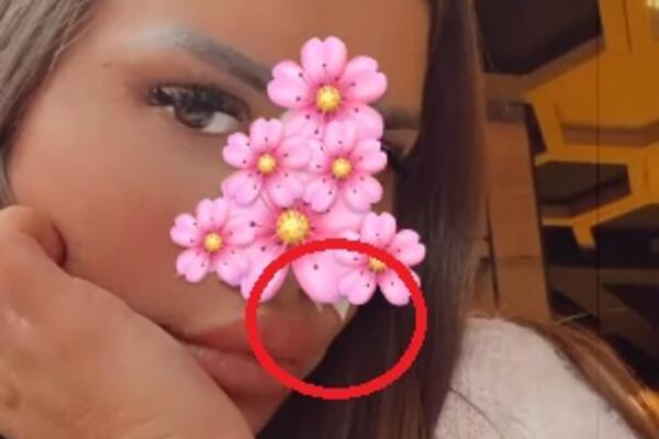 BIVŠA MODELSICA PONOVO POSETILA PLASTIČARA! Pre godinu dana je SMANJILA NOS, a sada želi još manji?! (FOTO)