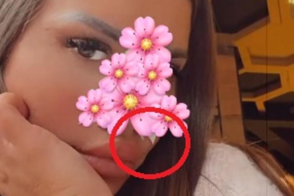 BIVŠA MODELSICA PONOVO POSETILA PLASTIČARA! Pre godinu dana je SMANJILA NOS, a sada želi još manji?! (FOTO)
