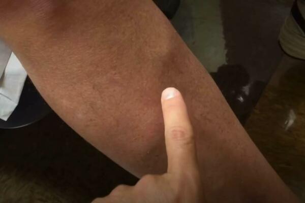 GRČEVI, OSETLJIVOST NOGU I OTICANJE: Simptomi zbog kojih morate da posetite lekara!