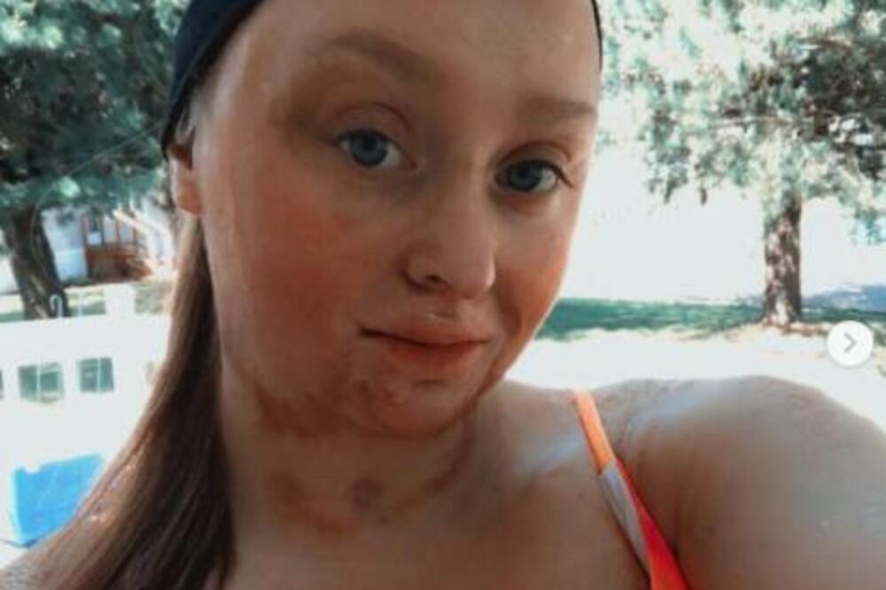 ZBOG BAKINOG RECEPTA ŽENA ZADOBILA JEZIVE OPEKOTINE: Završila sva SPRŽENA, horor FILM u REALNOM ŽIVOTU!