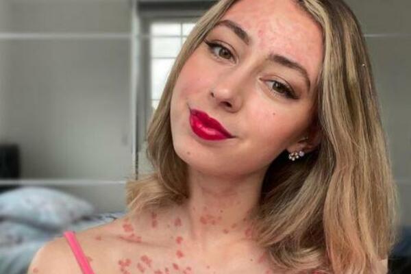 IMA SAMO 25 GODINA I NEIZLEČIVU BOLEST: Proširila joj se PO CELOM TELU, njene reči će vas naterati DA SE ZAPITATE!