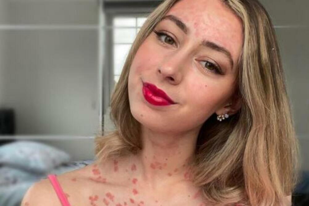 IMA SAMO 25 GODINA I NEIZLEČIVU BOLEST: Proširila joj se PO CELOM TELU, njene reči će vas naterati DA SE ZAPITATE!