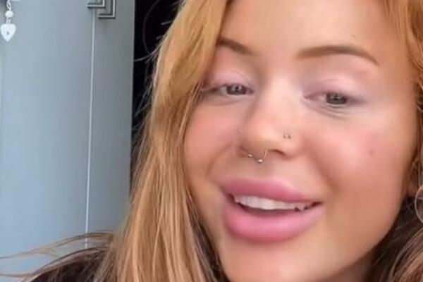 4 GODINE JE ZAVISNIK HIJALURONA U USNAMA: Sve faze TRANSFORMACIJA je snimila, KOMENENTARI su PRŠTALI (VIDEO)