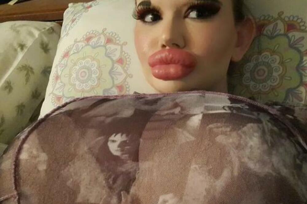 BUGARKA UBRIZGALA HIJALURON U SEBE, A LJUDI U NEVERICI: Svi se pitaju KAKO NE EKSPLODIRA, a ona neće da PRESTANE