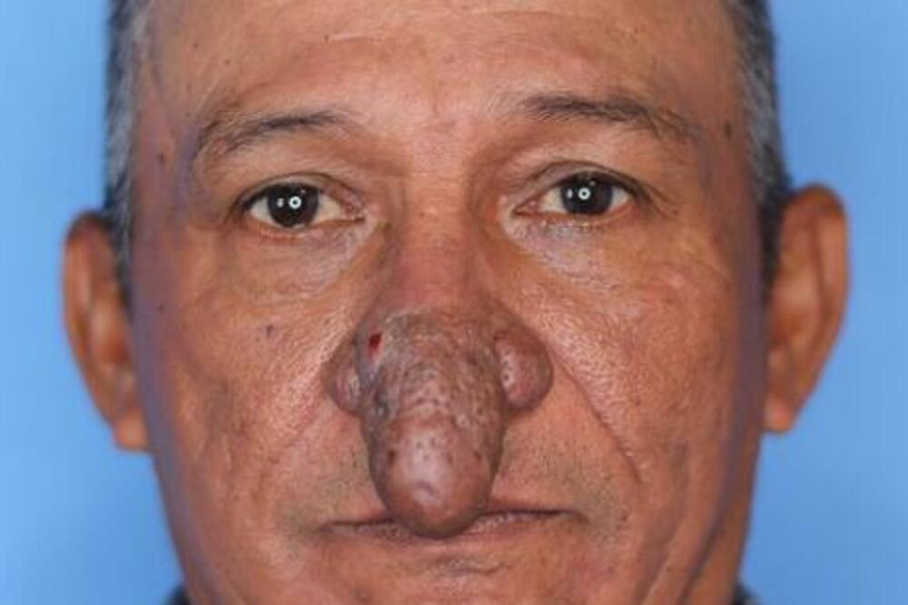 IZGLEDALO JE KAO DA IMA MALI POLNI ORGAN NA GLAVI! Slučajni susret sa hirurgom mu promenio ŽIVOT iz korena (FOTO)