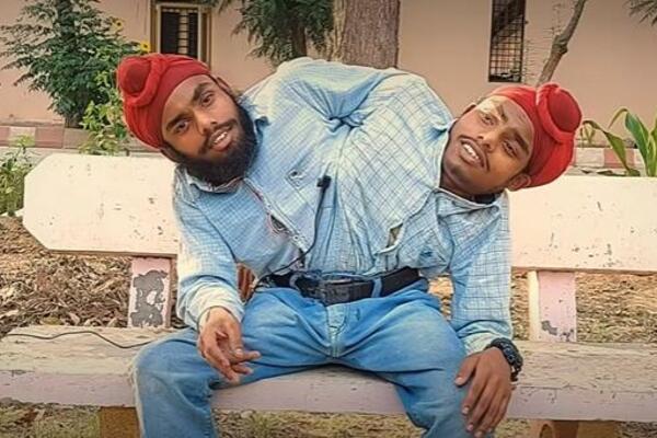 SIJAMSKI BLIZANCI DOBILI POSAO IZ SNOVA! Napušteni su dok su bili BEBE, lekari odbili da ih RAZDVOJE (VIDEO)