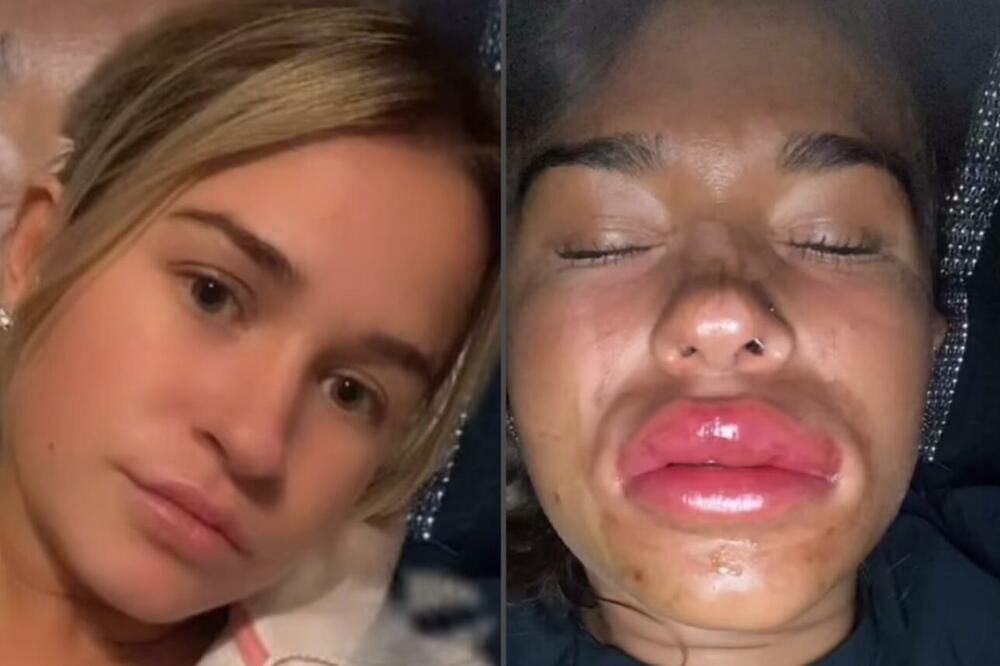 URADILA USNE PA NAPRAVILA UŽASNU GREŠKU: Probudila se u SUZAMA i bolovima, izgledala je JEZIVO (VIDEO)